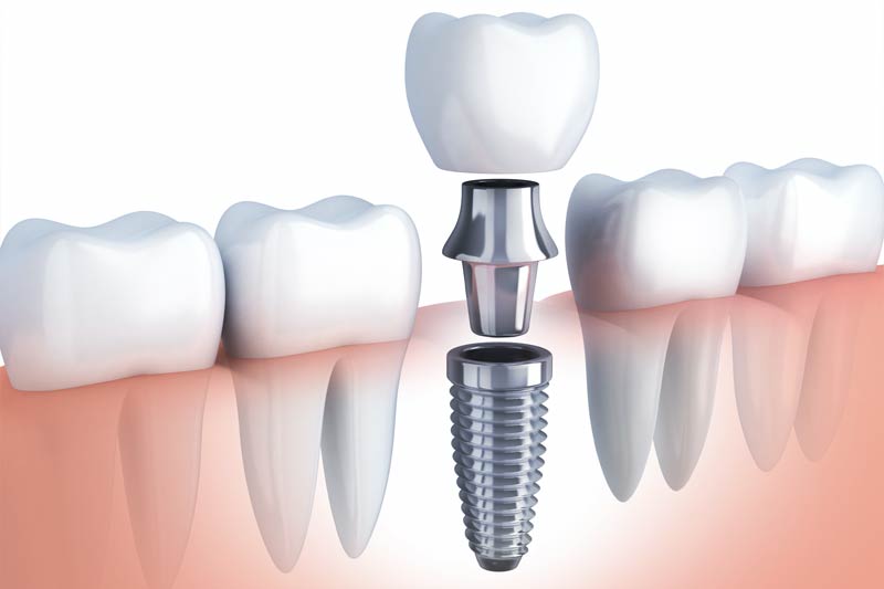 Implants Dentist in Wilbur