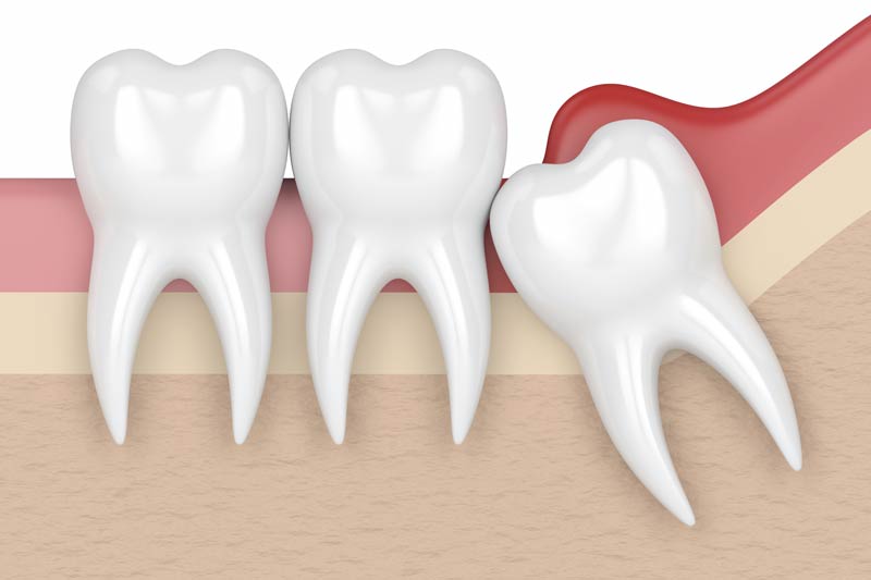 Wisdom Tooth Removal in Wilbur